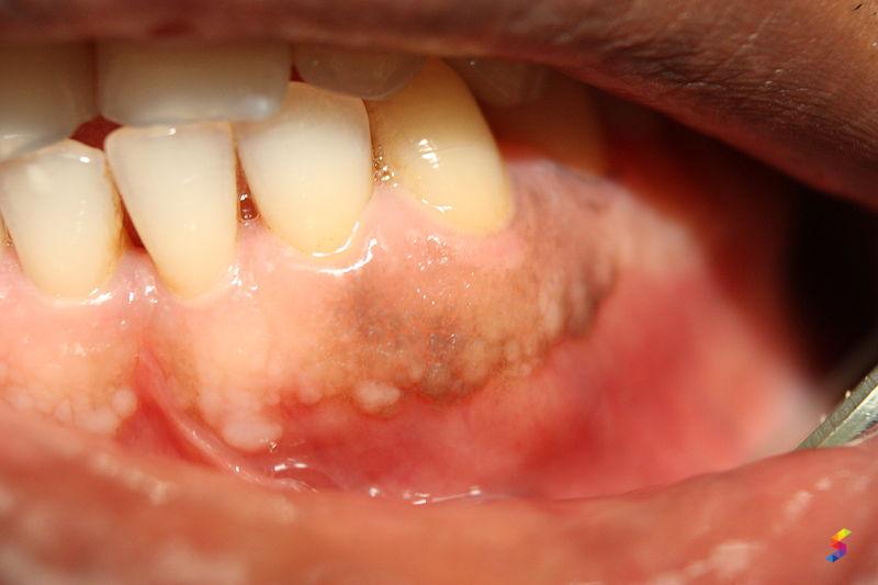 Define Gingivitis, Gingivitis Meaning, Gingivitis Examples, Gingivitis